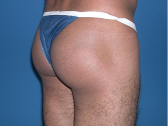 Buttock augmentation with implant 398796