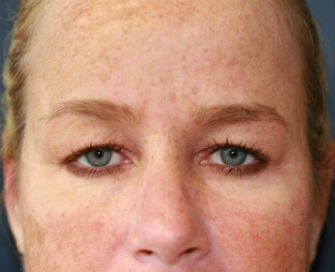 Blepharoplasty before 326444