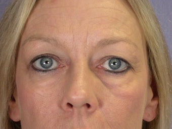 Eyelid Surgery before 306429