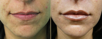 Hydrelle Injection For Treating Laugh Lines or Nasolabial Folds before 312791