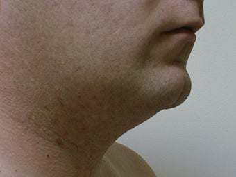 Liposuction of neck/chin area 590914