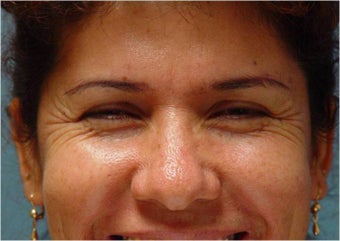 Botox Crow's feet before 251659