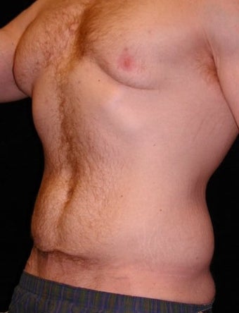 Male Tummy Tuck, Flank Liposuction, Male Breast Reduction 550017