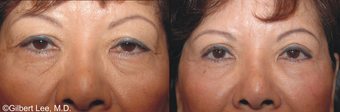 Asian Double Fold Eyelid Surgery before 376856