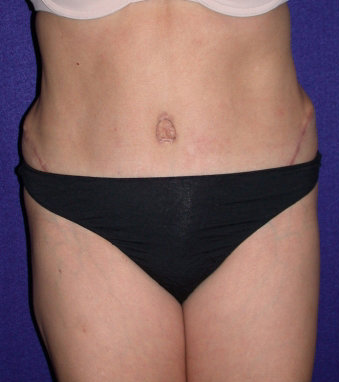 Tummy Tuck (abdominoplasty) after 208480