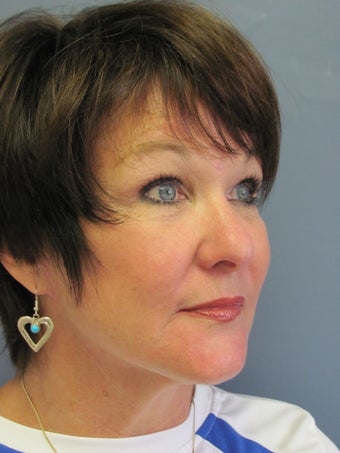 Chin Augmentation 635125