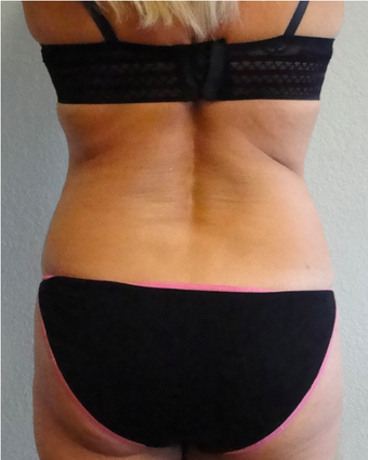 Exilis before 424084