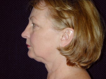Necklift before 233743