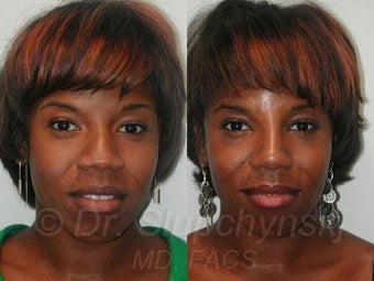 African American Rhinoplasty 374006