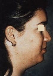 Chin Implant/Necklift/MiniLipo before 101596