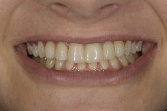 Resin bonding smile makeover on a teenager. before 326342