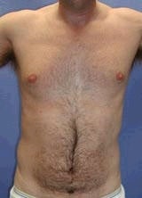 Pectoral Implants before 141617