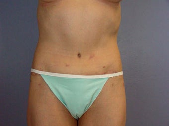 Tummy Tuck after 280113
