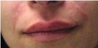 Juvederm after 272079