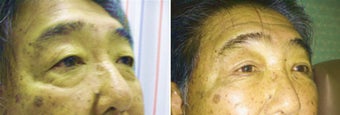 Cosmetic eyelid surgery before 128409