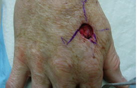 Skin Cancer Surgery on Hand before 561013