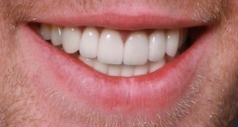 Trauma, Implants, Full Restoration after 389311