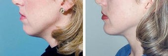 Chin Implant before 642983