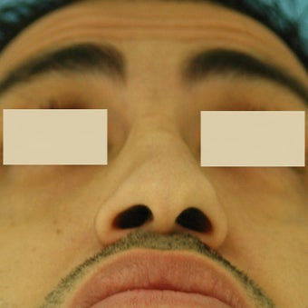Rhinoplasty, Septoplasty before 127178