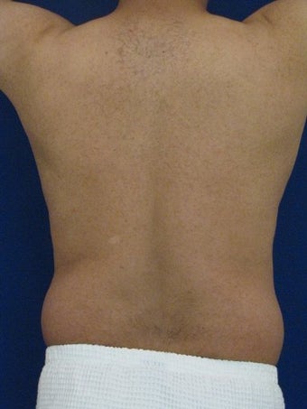 Vaser Hi Def Liposuction of chest, abdomen, back and flanks before 422695