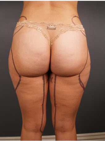 Tumescent Liposuction before 552078