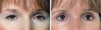 Blepharoplasty before 643239