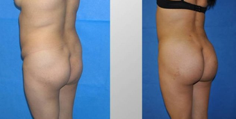 Butt Augmentation before 256426