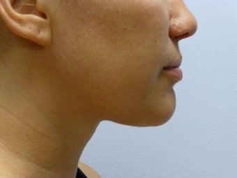 Liposuction to chin/neck area after 590814