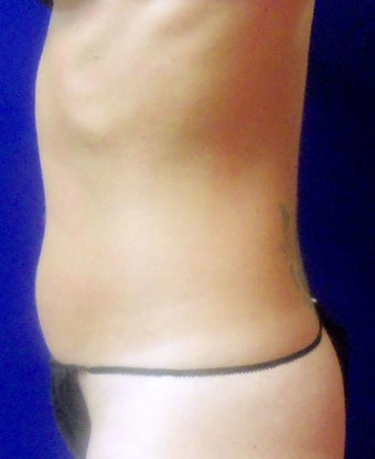 VASER Shape to Abdomen after 433053