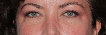 Restylane after 590808