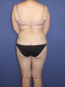 Thigh Lift before 329952