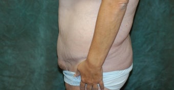 Women's Tummy Tuck Revision 558747