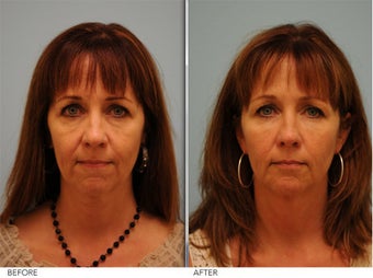 Restylane before 350403