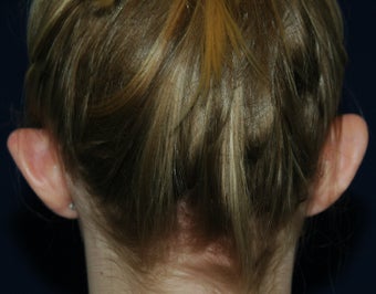 Otoplasty 565618