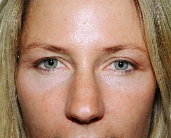 Upper eyelid blepharoplasty after 378934
