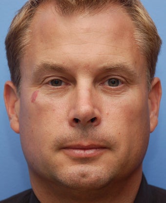 Cheek Dermafiller, Under Eye Dermafiller after 217102
