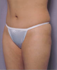 Abdominoplasty 428196