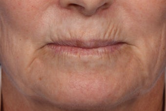 Botox and Juvederm before 309243