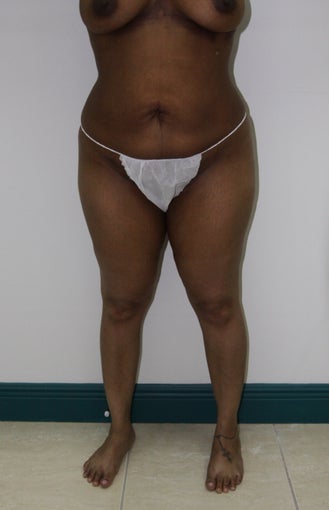 Brazilian Butt Lift after 505406