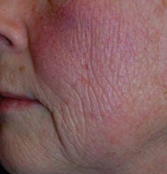 Total FX CO2 Laser before 564731