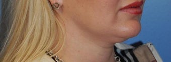 Lip Augmentation before 399264