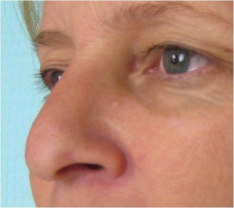 Radiesse on nose before 76996