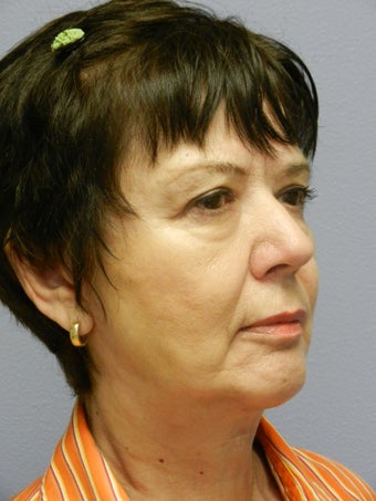 Lower Face Neck Lift after 574541