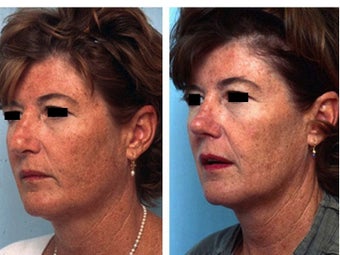 Rhinoplasty revision after 139113