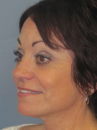 Lite Lift, Brow Lift after 523289