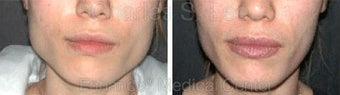 Jaw before 431332