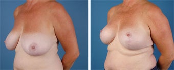 Breast Lift 355777