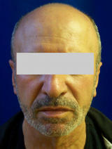 Ear Surgery (otoplasty) after 124910