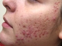 Acne/Acne Scars Treatment with Smoothbeam before 272003