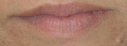 Lip enhancement with Restylane before 93352